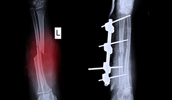 МОЗ передало в регіони апарати зовнішньої фіксації для лікування пацієнтів із переломом кісток